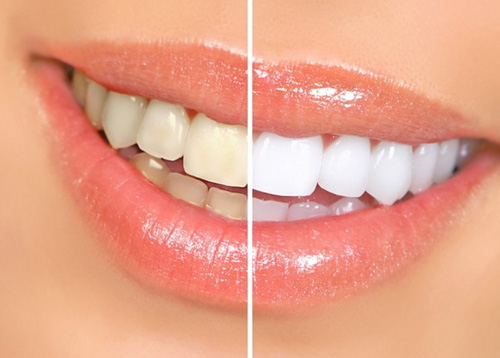 Отбеливание зубов: до и после